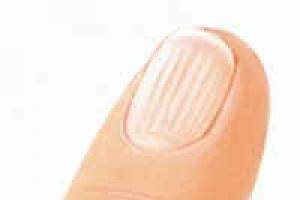 Причины волнистых ногтей на больших пальцах рук